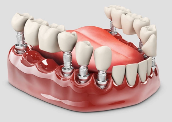 Dental Bridge & Crown