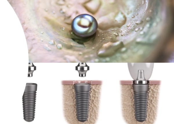 Dental Implants