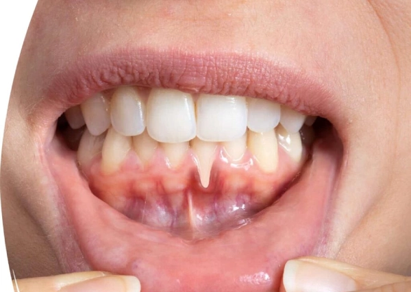 Gum Disease Treatment
