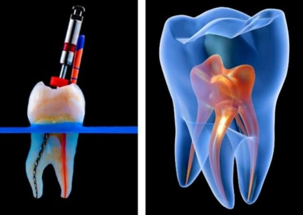 Root Canal Treatment