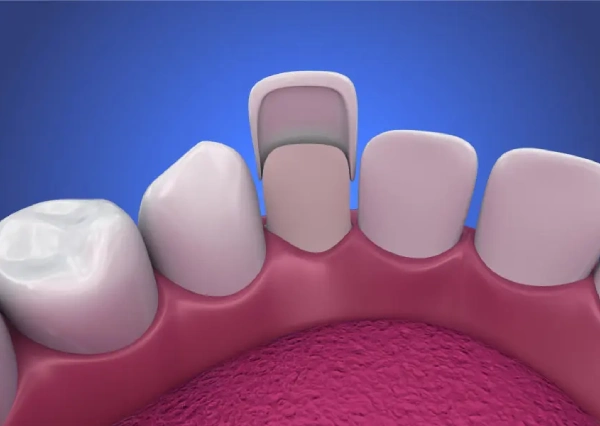 Veneers & Lumineers
